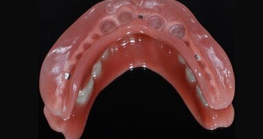 Rehabilitacja uzębienia za pomocą protez teleskopowych – opis przypadku