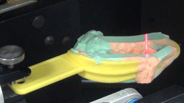 La CFAO dentaire facile au fauteuil avec le scan d’empreinte silicone