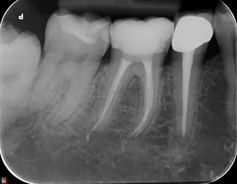 Fig. 13b: Radiographic follow-up view of tooth #46 after endodontic treatment and restoration.