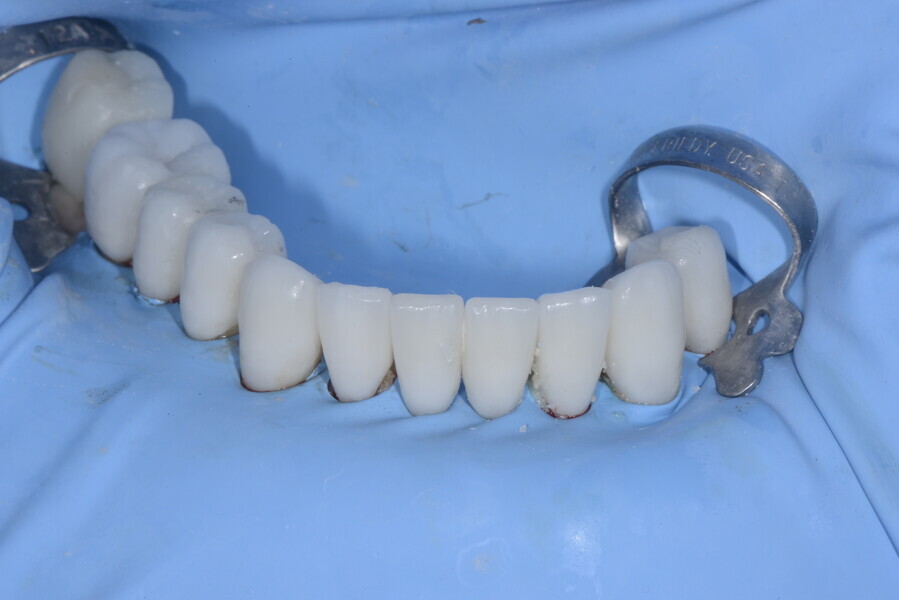 Figs. 25a & b: Cementation of the ceramic veneers under dental dam isolation
