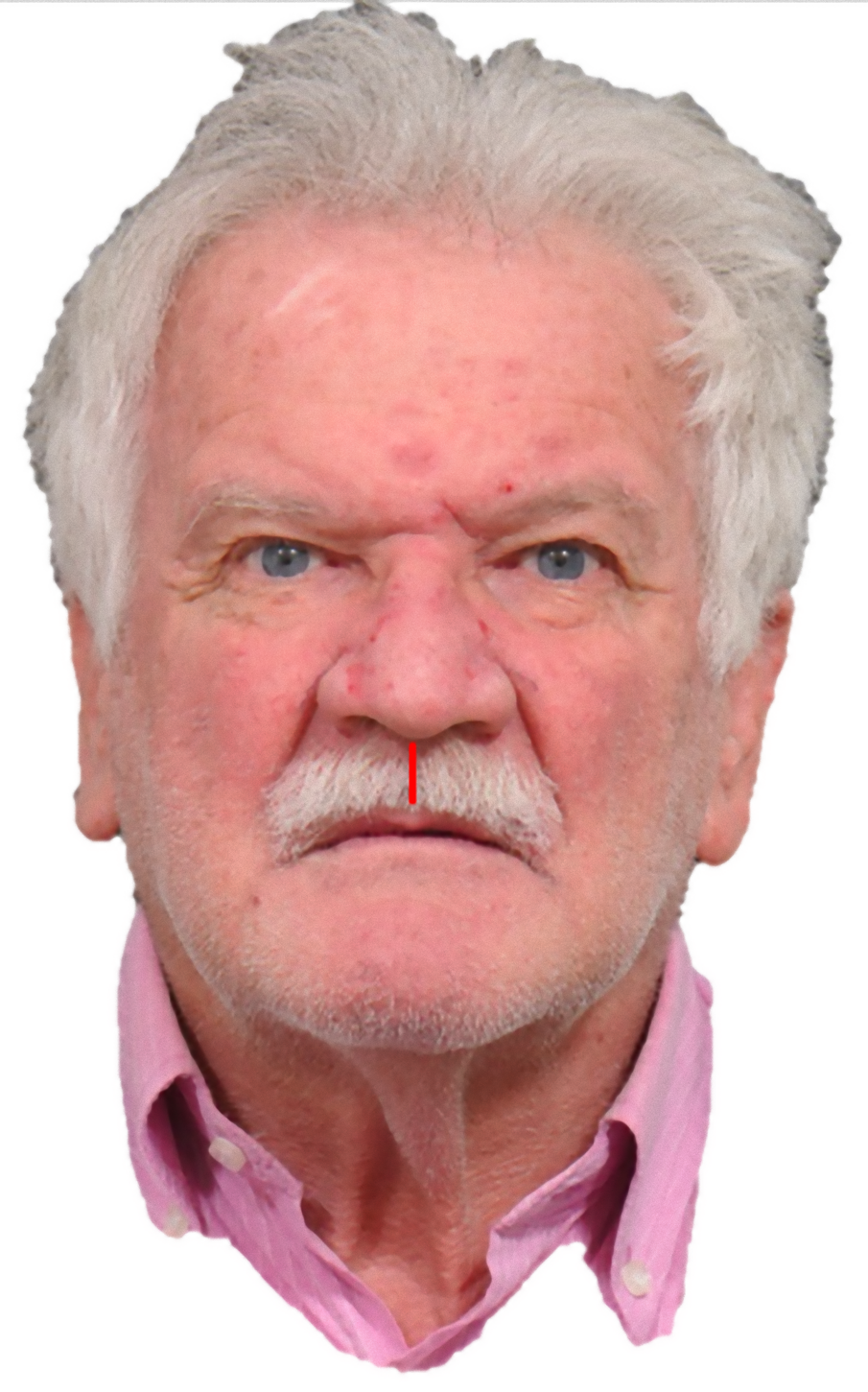 Fig. 3_Lunghezza del labbro superiore (Sn-Sto). La lunghezza standard del labbro superiore è di 19-22 mm.