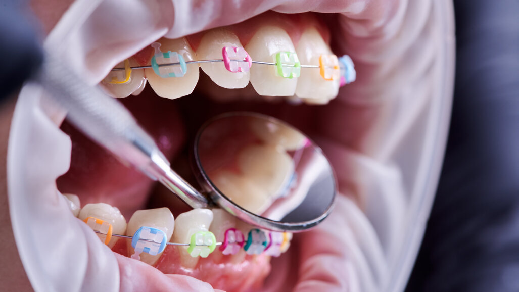 SPÖ-Bundesländer blockieren Neuregelung der Kieferorthopädie