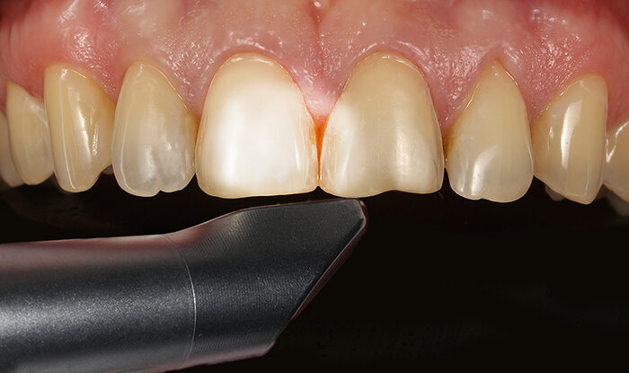 Fig. 6: The clinical situation was scanned with the CEREC Omnicam.