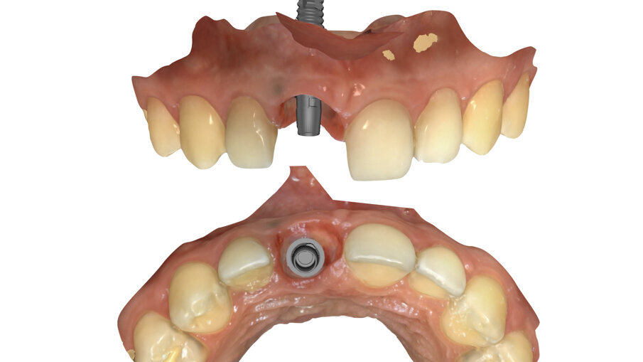 Fig. 31_Maschera gengivale definitiva.