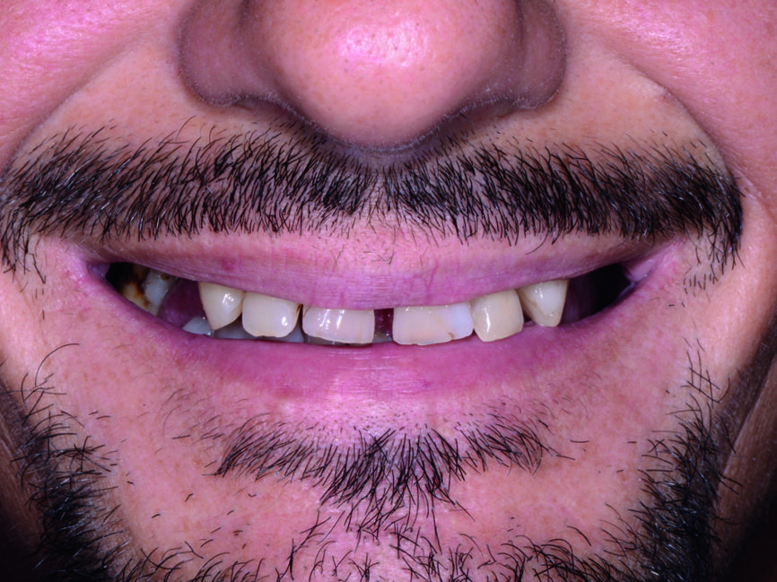 Fig. 1 : Vue extra-orale préopératoire.