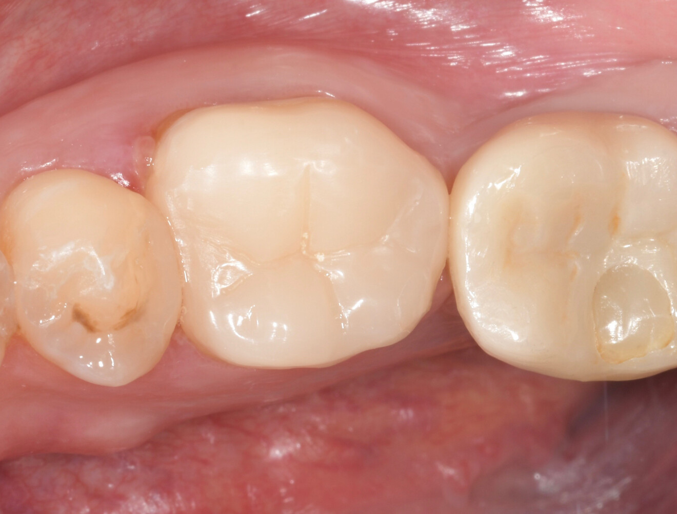 Fig. 25a: Clinical post-op view of tooth #36 after endodontic treatment and restoration.