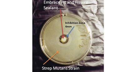 Pulpdent Embrace Pit and Fissure Sealant Pulpdent Embrace Pit and Fissure Sealant