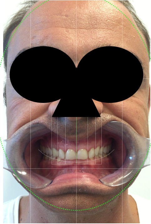 Fig. 5: DSD protocol: image of patient smiling wearing a lip and cheek retractor.