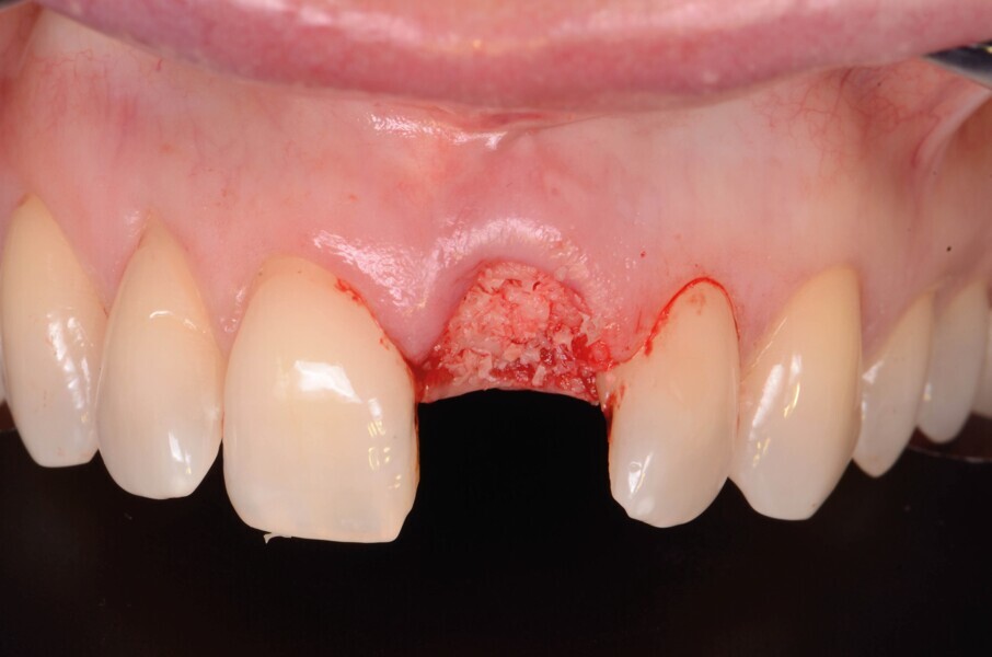 Fig. 5d : L’alvéole est comblée par un greffon allogénique (poudre d’os PHOENIX, TBF).