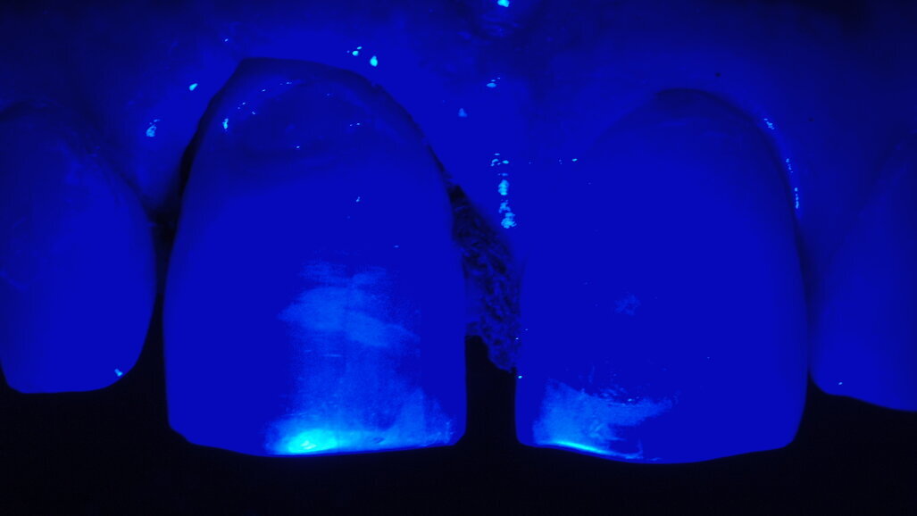 Soluciones a la diferencia de color de los dientes