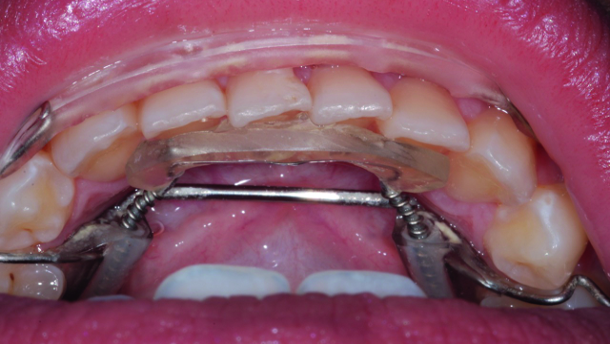 Conservative smile design for the general dentist