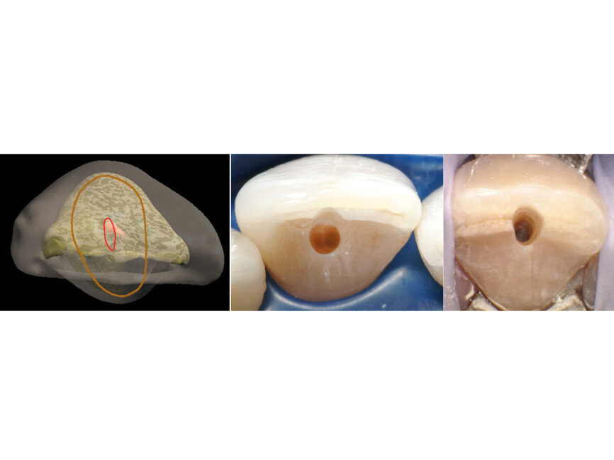 Fig. 5: In anterior teeth, the canal orifice is typically located just lingual to the incisal edge in incisors and the cusp tip in canines (middle) or directly under the incisal edge or cusp tip (right). 