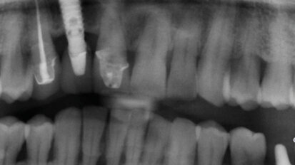 Impianti a connessione conometrica: semplificazione protesica in zona anteriore