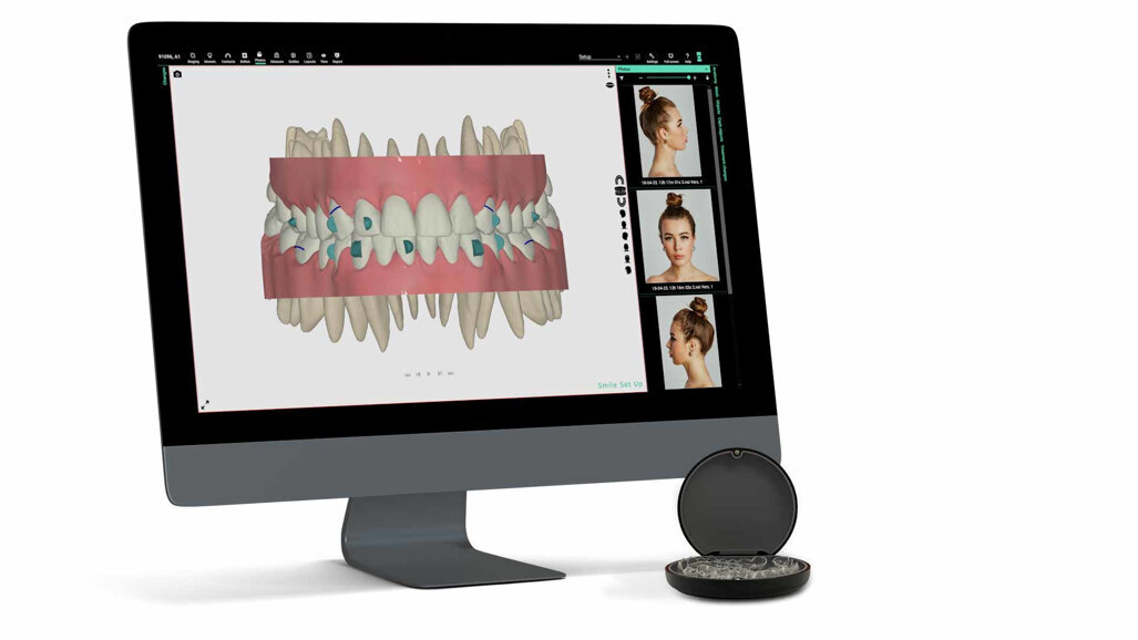 Smilers clear aligner system launches in the UK