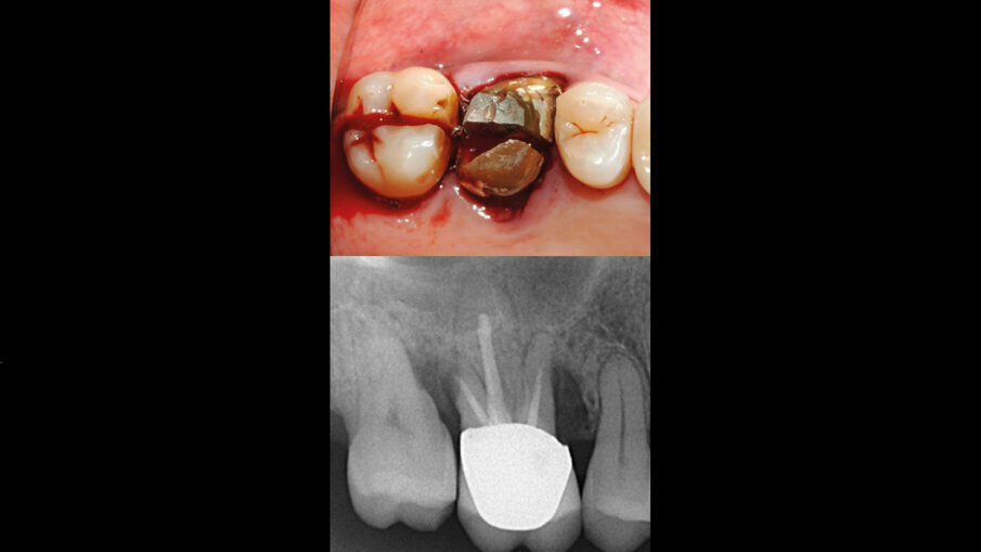 Fig. 1 - Visione occlusale che mostra gli elementi 26-27 irrecuperabili. Sotto, l’RX iniziale.