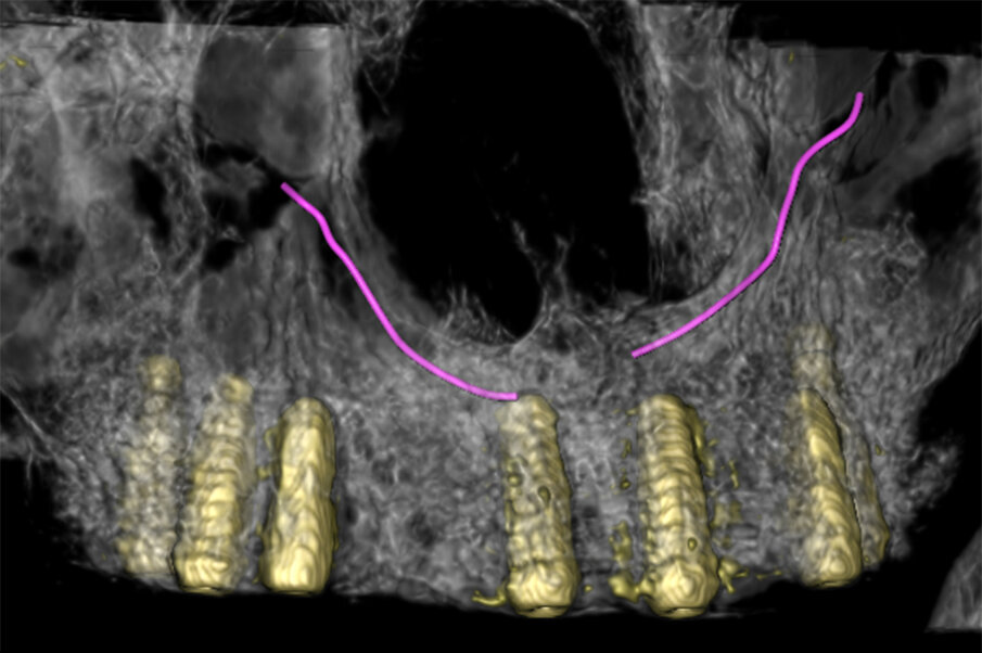 Fig. 7 - Volume rendering con CS in evidenza.
