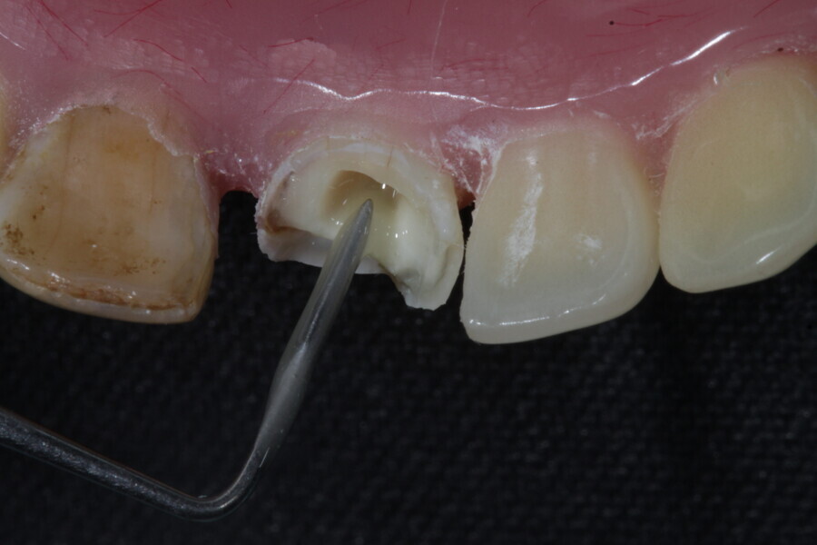 Fig. 7: Dual-polymerising resin cement is applied into the canal.