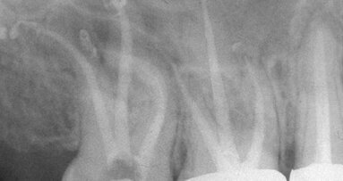 Is rotary NiTi the new paradigm?