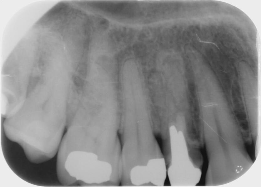 Fig. 5 : Radiographie préopératoire.