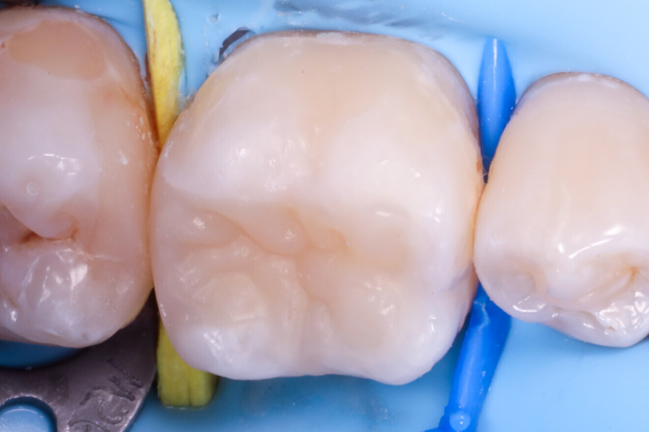 Fig. 25: After excess removal and polishing of the restoration.