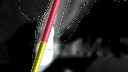 Fig. 3a: Planning the initial drill path using a custom implant design (red) to match the
diameter of the initial drill to reach the tooth apex. The abutment projection is shown in yellow.