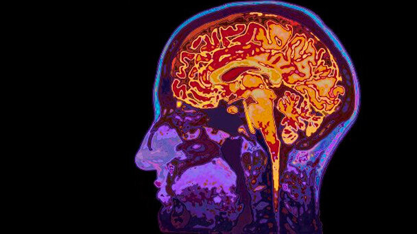 Scoperto un legame tra batteri orali, microemorragie cerebrali e ictus
