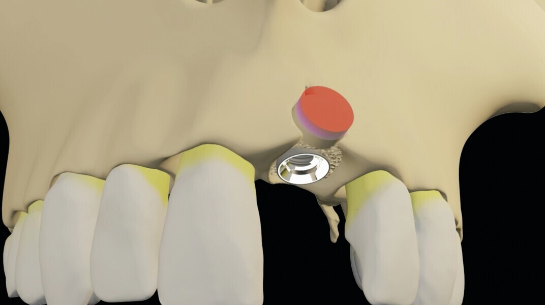 Fig. 27 : La répartition des différents éléments autour de l‘implant. 