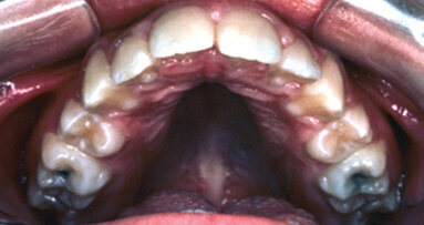 An interview with orthodontic appliance inventor Earl O. Bergersen