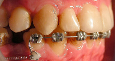 Extreme Smile Makeover: risoluzione clinico-estetica di una dismorfia facciale dento-scheletrica di classe III