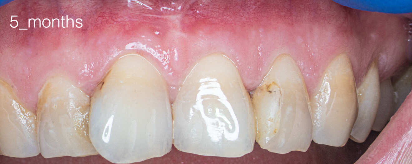 Fig. 5: Clinical situation after five months. No visible signs of inflammation.