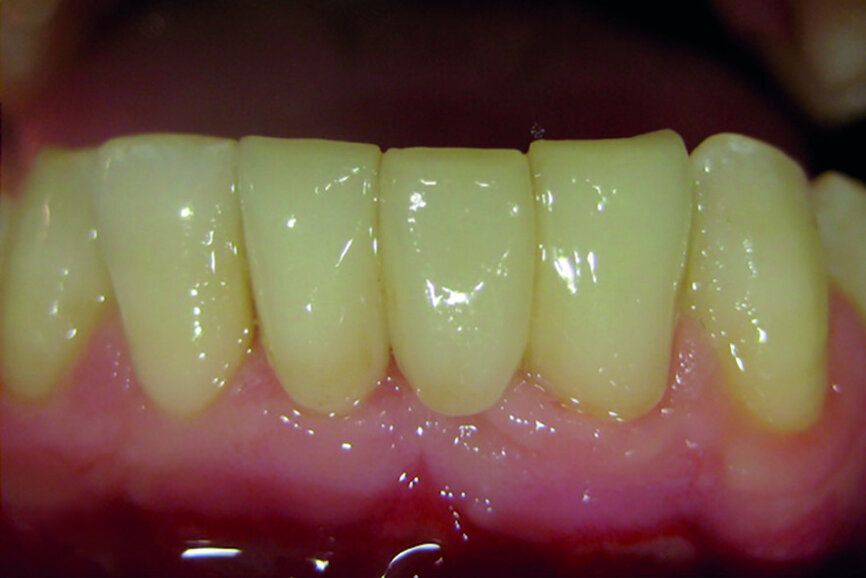 Fig. 13b: Anterior temporary crown printed using a preliminary CEREC 3-D Redcam impression. CAD of the IPS e.max FDP on CEREC inLab 4.3 (a).
Bonded IPS e.max bridge (b).