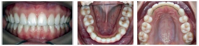 Photos taken at the end of treatment (total of 23 months – 2 appointments in 12 months)