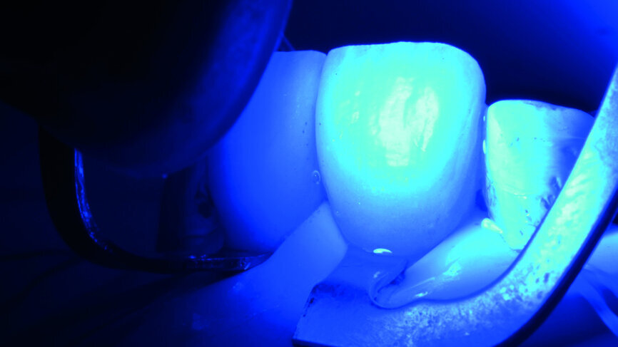 Fig. 16d: Final polymerisation of the veneers.