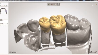 Timski igrači: efikasnost i estetika  -  Nadoknade pune morfologije napravljene od translucentnog cirkonijum-dioksida
