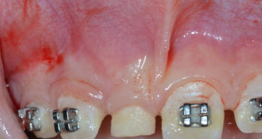 Diagnosi e trattamento multidisciplinare di un odontoma composto.  Descrizione di un caso clinico