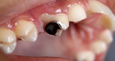 Editorial: Can we rebuild the lost enamel?