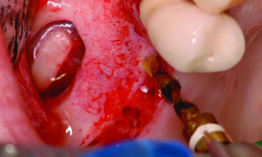 Fig. 9_Fasi dell’osteotomia implantare.