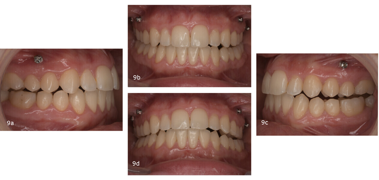 Figs. 9a–d: Situation after the 20th aligner pair (FACE reset).