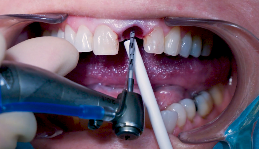 Fig. 5_Osteotomia iniziale con trapano ad ago. 