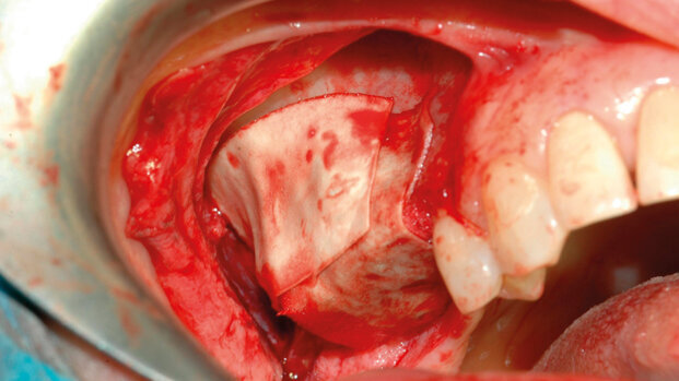 Criteri di prevedibilità nell’aumento dei volumi ossei: biomateriali o sostituti ossei?