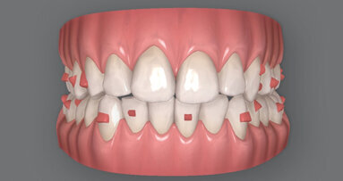 Traitement orthodontique par aligneurs transparents d’une malocclusion complexe