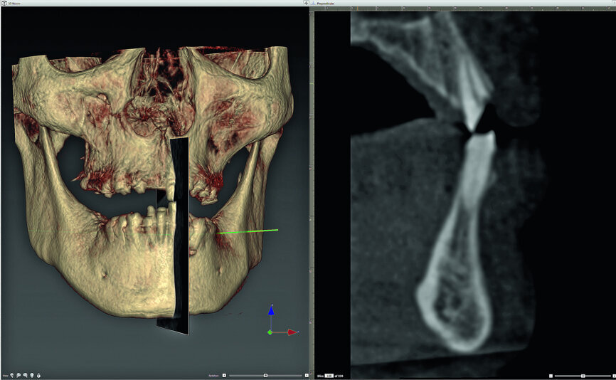 Fig. 1: Three-dimensional volumetric rendering of the maxilla-mandibular relationship (r), and a sagittal section (l) of this region of interest.