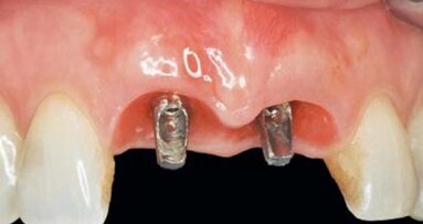 Czy recesja tkanki miękkiej wokół implantów wciąż jest nieunikniona? – część 2