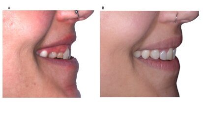 Piano di trattamento digitale in un caso di agenesia dentale multipla anteriore