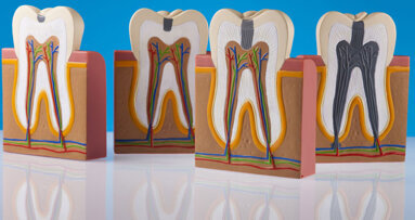 So können Peptide die Kariesbehandlung revolutionieren