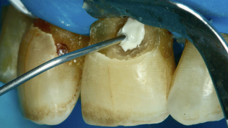 Se coloca silicato de calcio modificado por resina por la proximidad a la pulpa. 