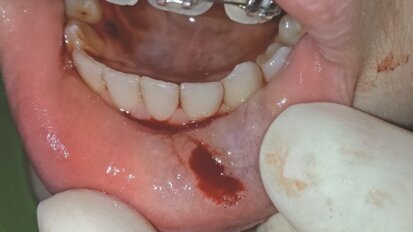 Leczenie mucoceli laserem the Er:YAG – opis przypadku