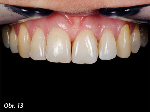 Obr. 13: Kontrola po 4 měsících.