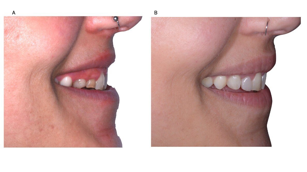 Piano di trattamento digitale in un caso di agenesia dentale multipla anteriore