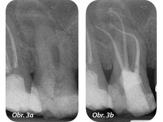 Zahnuté kanálky jsou náročné na opracování, vyčištění a plnění